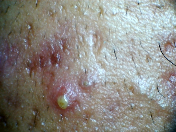 Example of acne skin rash